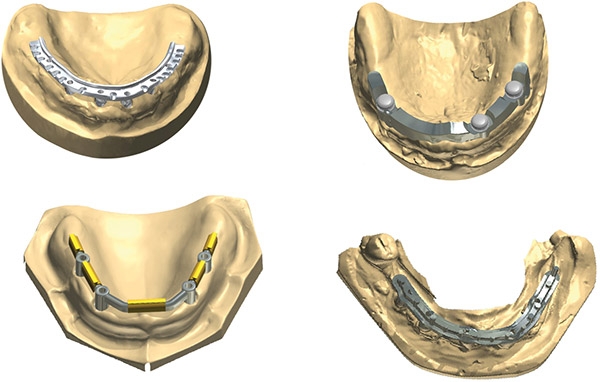 Фото ПО для стоматологии Abutment Designer and Implant Bar and Bridge Design_2